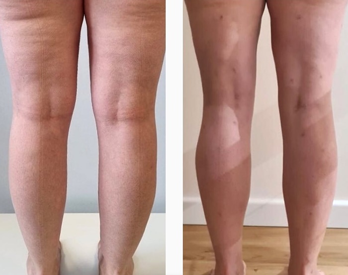 lipedema-antes-e-depois08.jpg