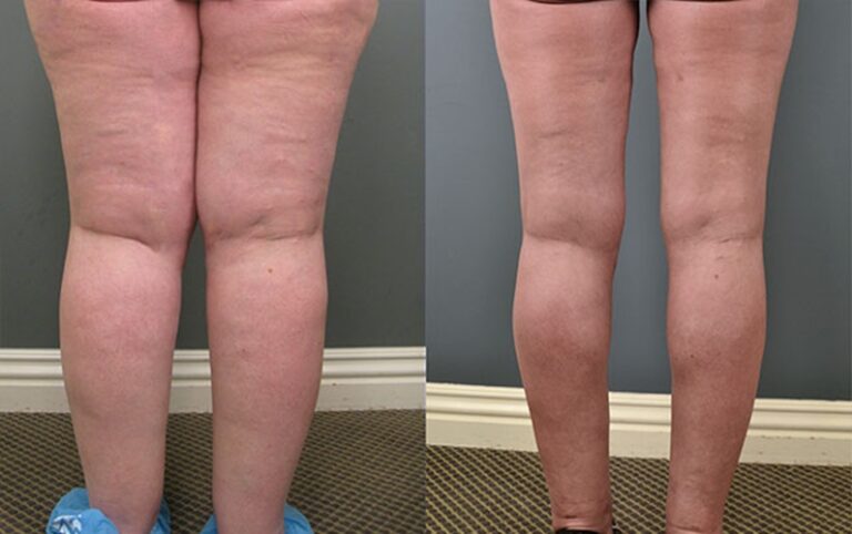 lipedema-antes-e-depois19.jpg